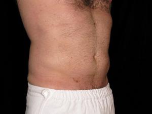 Post-operative patient photo for Safe Lipo at Restora Austin Plastic Surgery Centre in Austin, TX