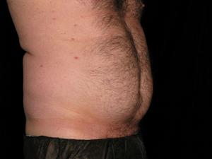Pre-operative patient photo for Safe Lipo at Restora Austin Plastic Surgery Centre in Austin, TX