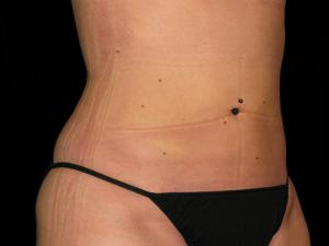 Patient after Safe Lipo at Restora Austin Plastic Surgery Centre in Austin, TX