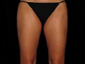 After Safe Lipo, Patient photo at Restora Austin Plastic Surgery Centre, Austin, TX