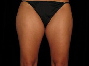 Before Safe Lipo, Patient photo at Restora Austin Plastic Surgery Centre, Austin, TX