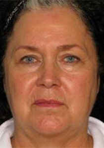 Pre-operative patient photo for Arm Lift at Restora Austin Plastic Surgery Centre in Austin, TX