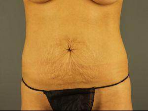Pre-operative patient photo for Tummy Tuck 360 at Restora Austin Plastic Surgery Centre in Austin, TX