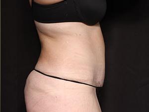 Patient after Tummy Tuck 360 at Restora Austin Plastic Surgery Centre in Austin, TX