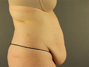 Patient before Tummy Tuck 360 at Restora Austin Plastic Surgery Centre in Austin, TX