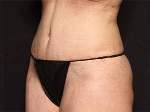 After Tummy Tuck 360,Patient photo at Restora Austin Plastic Surgery Centre, Austin, TX
