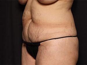 Before Tummy Tuck 360, Patient photo at Restora Austin Plastic Surgery Centre, Austin, TX