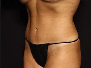 Patient after Abdominoplasty at Restora Austin Plastic Surgery Centre in Austin, TX