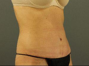 After Abdominoplasty,Patient photo at Restora Austin Plastic Surgery Centre, Austin, TX