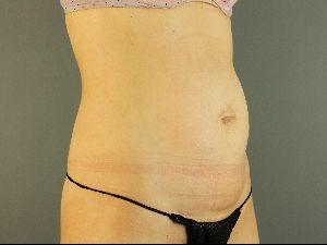 Before Abdominoplasty, Patient photo at Restora Austin Plastic Surgery Centre, Austin, TX
