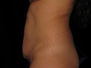 Pre-operative patient photo for Abdominoplasty at Restora Austin Plastic Surgery Centre in Austin, TX