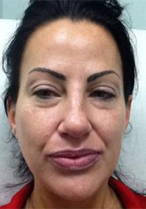 Patient before Neurotoxin at Restora Austin Plastic Surgery Centre in Austin, TX