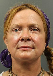 Patient after FaceLift at Restora Austin Plastic Surgery Centre in Austin, TX