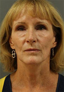 After FaceLift, Patient photo at Restora Austin Plastic Surgery Centre, Austin, TX