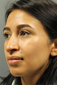 Patient before Rhinoplasty at Restora Austin Plastic Surgery Centre in Austin, TX