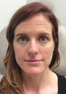 Pre-operative patient photo for Neurotoxin at Restora Austin Plastic Surgery Centre in Austin, TX
