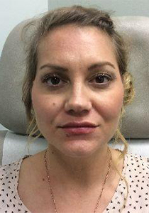 After undergoing Dermal Fillers, Patient photo at Restora Austin Plastic Surgery Centre, Austin, TX