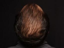 hair-restoration-austin-tx