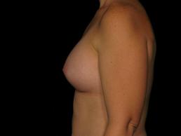breast-augmentation-austin-tx