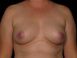 breast-augmentation-austin-tx