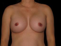 breast-augmentation-austin-tx