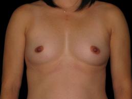 breast-augmentation-austin-tx