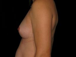 breast-augmentation-austin-tx