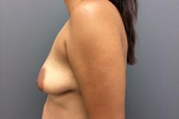 augmentation-lift-austin-tx