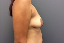 augmentation-lift-austin-tx