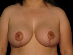 augmentation-lift-austin-tx