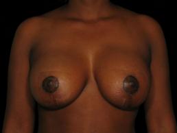 augmentation-lift-austin-tx