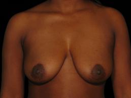 augmentation-lift-austin-tx