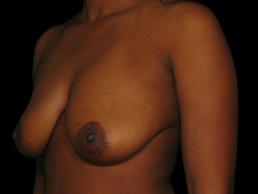 augmentation-lift-austin-tx