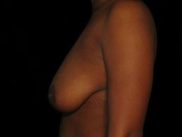 augmentation-lift-austin-tx