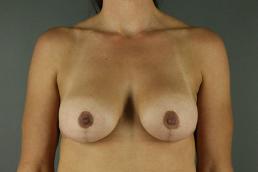 augmentation-lift-austin-tx