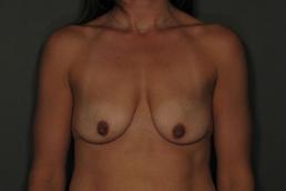 augmentation-lift-austin-tx