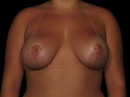 augmentation-lift-austin-tx