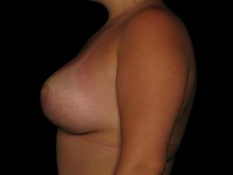 augmentation-lift-austin-tx