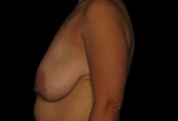 augmentation-lift-austin-tx