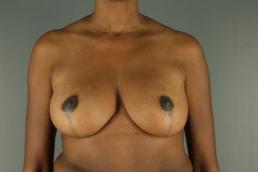 augmentation-lift-austin-tx