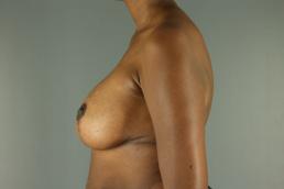 augmentation-lift-austin-tx