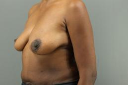 augmentation-lift-austin-tx