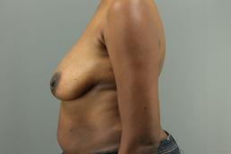 augmentation-lift-austin-tx