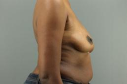 augmentation-lift-austin-tx