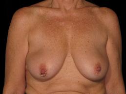 augmentation-lift-austin-tx