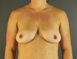 augmentation-lift-austin-tx