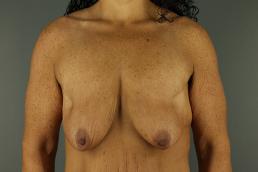 augmentation-lift-austin-tx