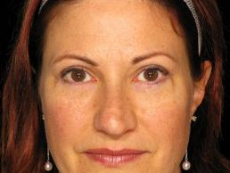 blepharoplasty-austin-tx