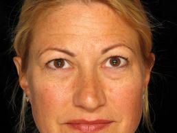 blepharoplasty-austin-tx