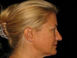 blepharoplasty-austin-tx